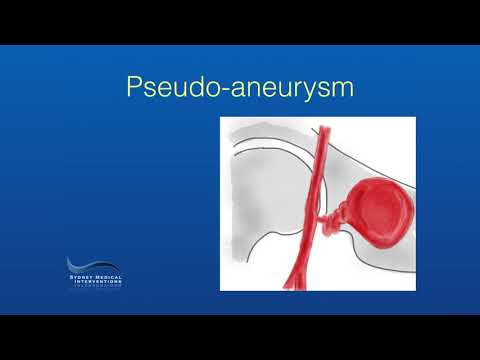 Endovascular Treatment of a Femoral Pseudo-aneurysm