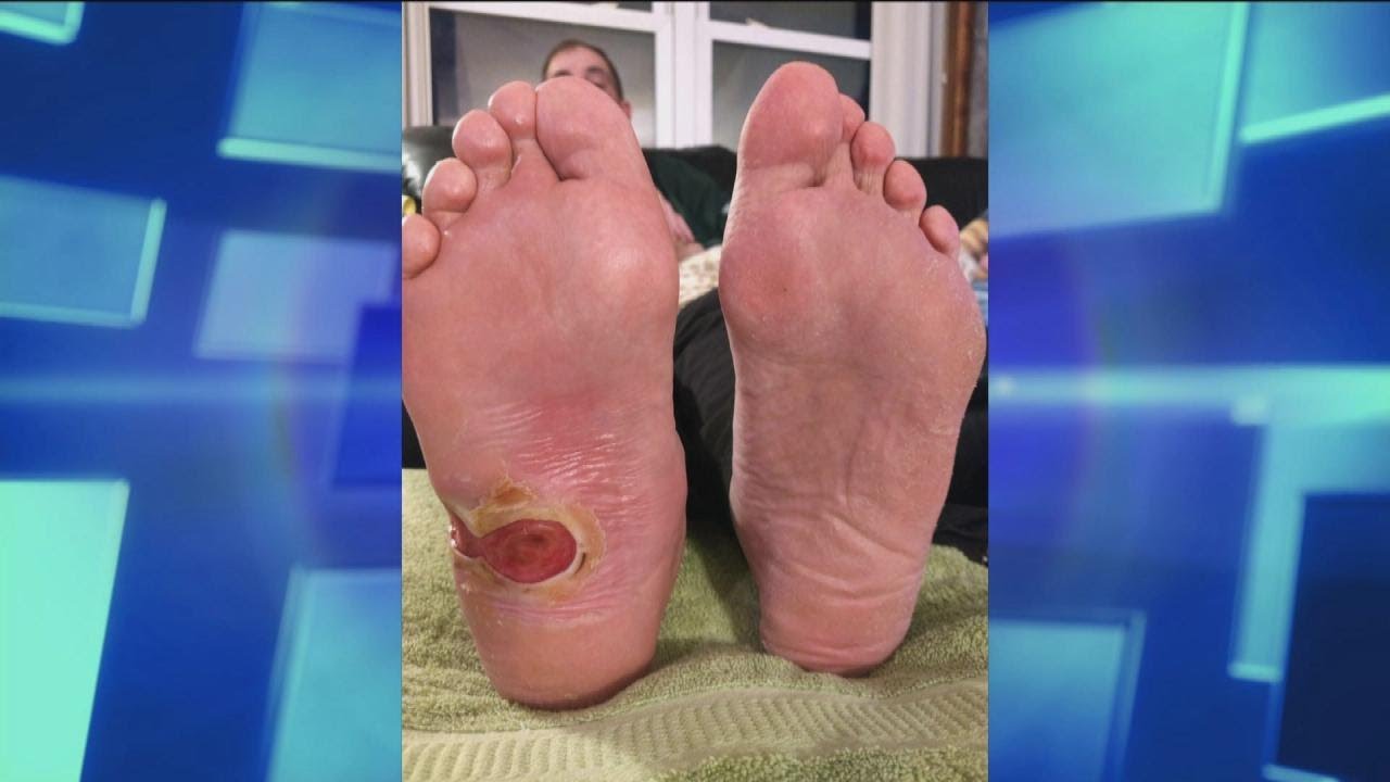 How Diabetic Foot Ulcers Occur Youtube