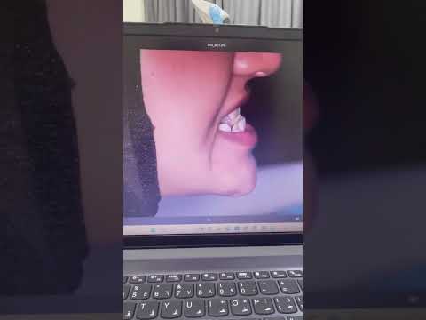 علاج تراجع الفك العلوي و تقدم الفك السفلي بالتقويم بدون جراحة عمان الاردن