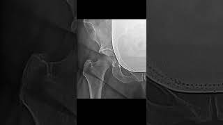 Things Found In An X Ray | Radiography of the hip joint | Radiological Survey Images #shorts