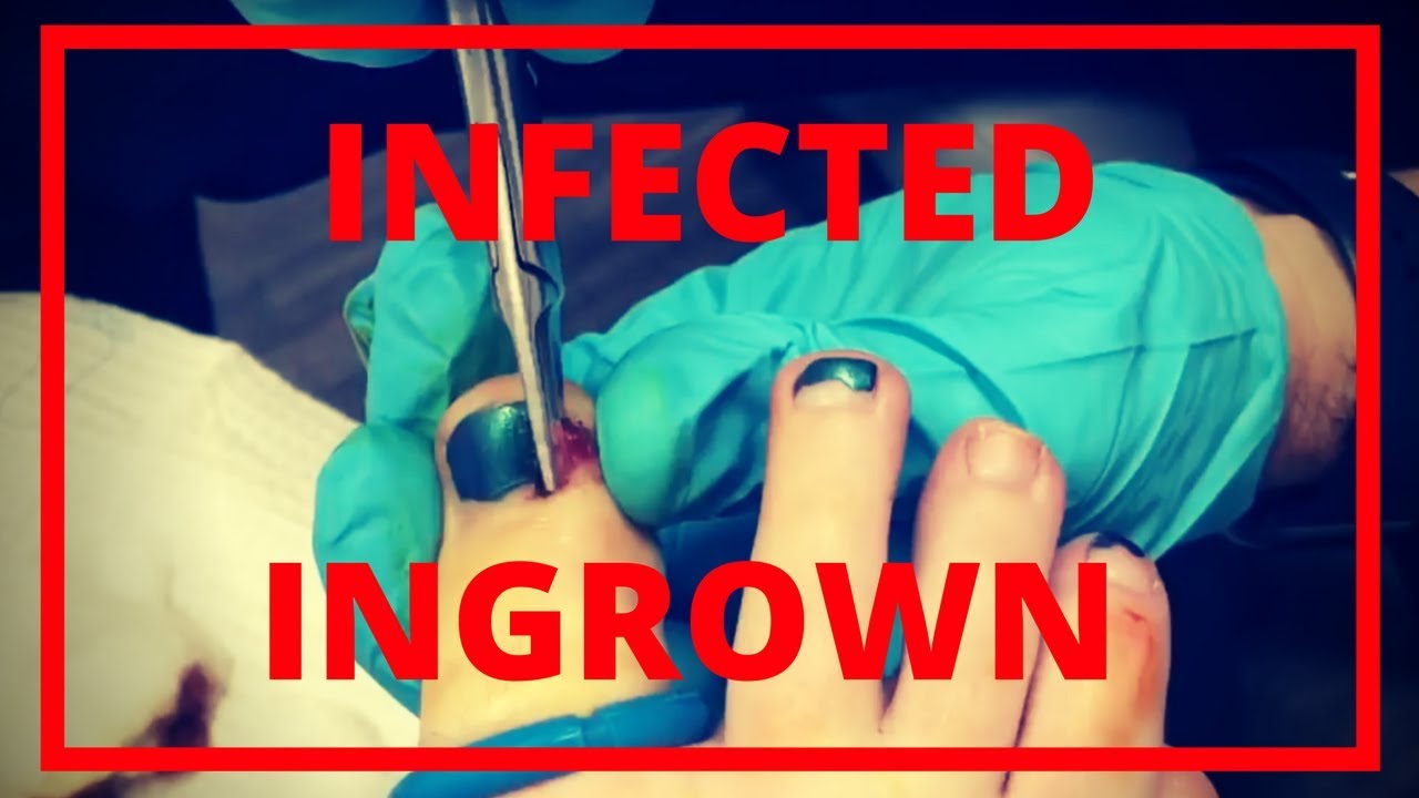 Ingrown toenail removal for infected toe Tampa Podiatrist YouTube
