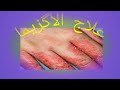 علاج الأكزيما في ثلاثة أيام ولن تعود أبدا