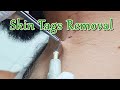 How to remove skin tags around neck with electric cautery  skin tag removal procedure