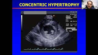 Guideline Webinar: Recommendations for Multimodality Cardiovascular Imaging of Patients with HCM