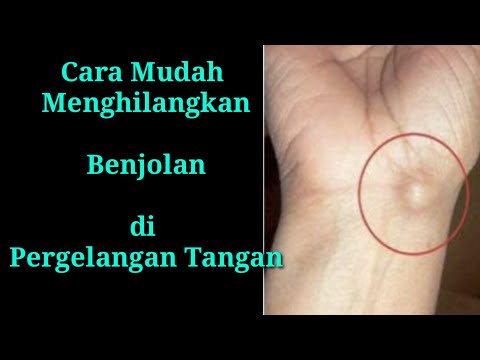 Menghilangkan Benjolan d pergelangan tangan (GANGLION), Mudah, Murah dan Efektif.