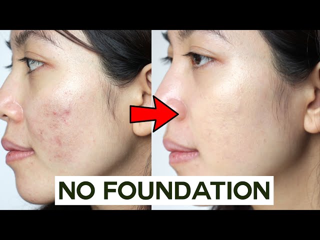 how to cover acne scars without makeup