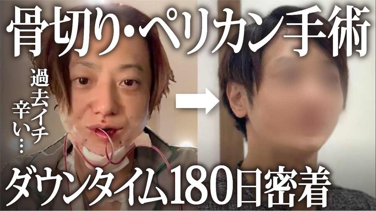 『過去イチ辛い...』骨切り＆ペリカン手術ダウンタイム半年分全部見せ