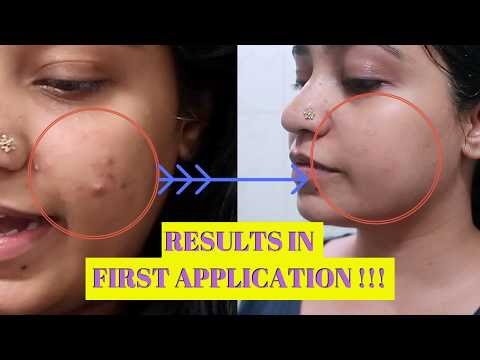 Acne Treatment For PCOS | Natural Home Remedy for PCOD Cystic Acne