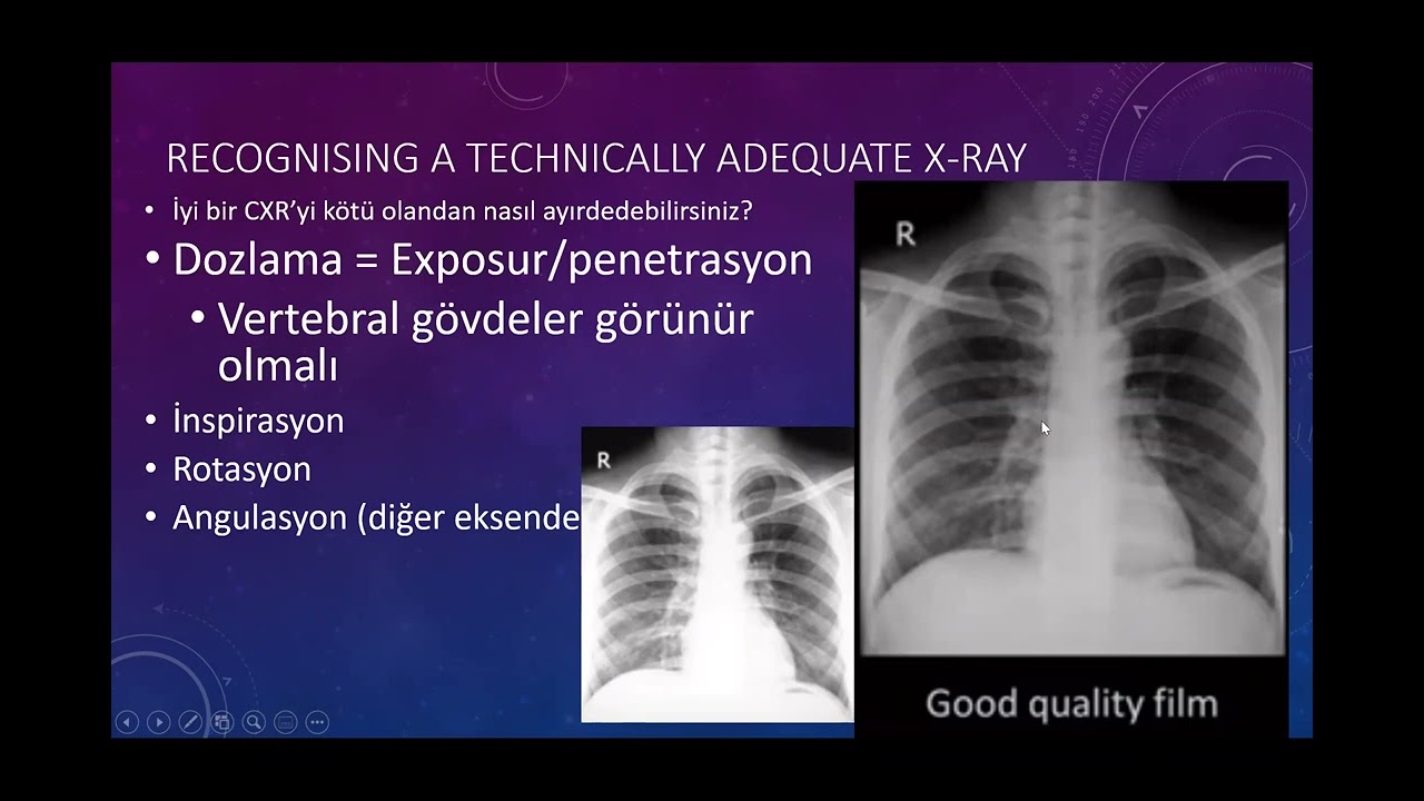 Akciğer Grafisi 1 - Projeksiyonlar, teknik değerlendirme, terminoloji.