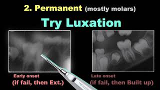Treatment of Ankylosis - Part 1｜【Chris Chang Ortho】CC762