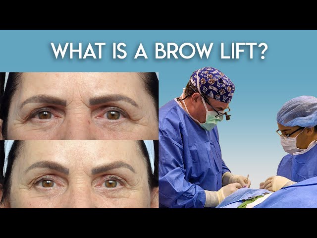 What is Brow Lift?