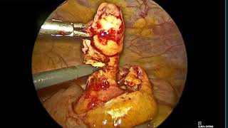 Complicated appendectomy - Submucosal dissection