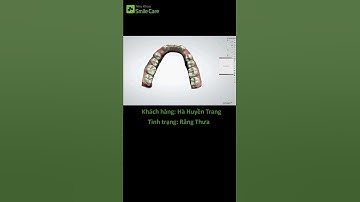 VIDEO 3SHAPE KHÁCH HÀNG HUYỀN TRANG - NIỀNG TRONG SUỐT SMILESALIGN