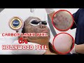 CARBON LASER PEEL Before and After [How it works? I tried for the first time]