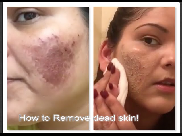 How to remove dead skin after Micro needling| Vlog Day 4 - YouTube
