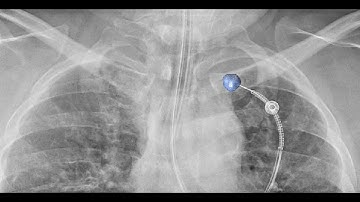 Cone-Beam CT Master Class for Advanced Bronchoscopy and Interventional Pulmonology.
