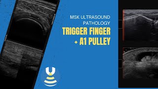 Thickened A1 pulley demonstrated on ultrasound