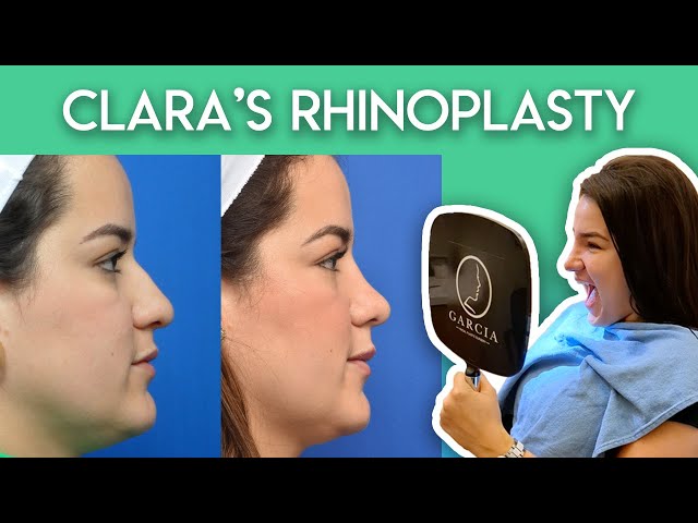 Clara's Rhinoplasty Journey