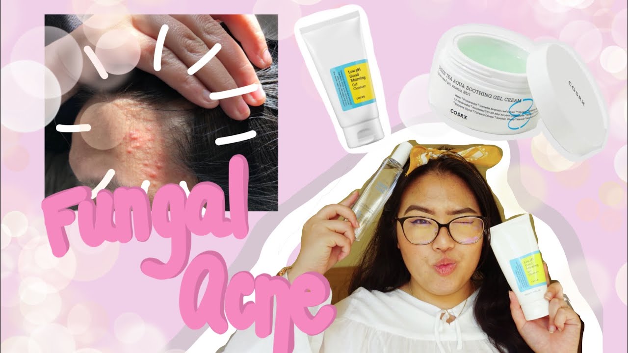 My Fungal Acne Journey/Skincare | Khumphet