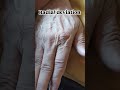 after hairline fracture of radius bone ( shaft), wrist and forearm exercises #fracturemanagement