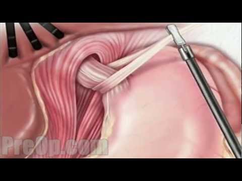 Hernia Hiatal Laparoscopic Surgery PreOp® Patient Education