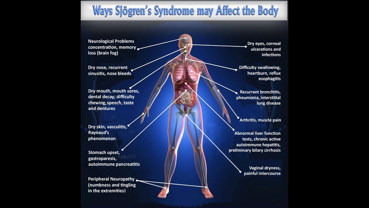 Sjogren Syndrome Neurological Symptoms Captions Update Trendy