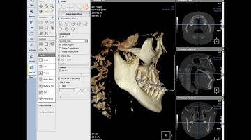 3D Ceph Superimposition