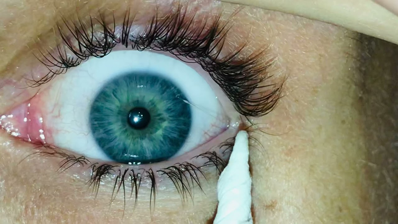 Eye mucous fishing syndrome YouTube