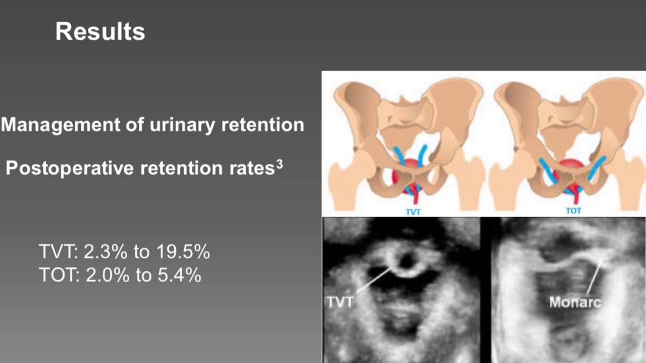 ICS 2020 Abstract #633 URINARY RETENTION AFTER MID-URETHRAL TAPE ...