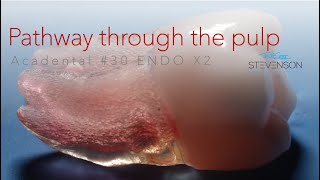 Dental Pulp - Pathway Through the Pulp - Acadental #30