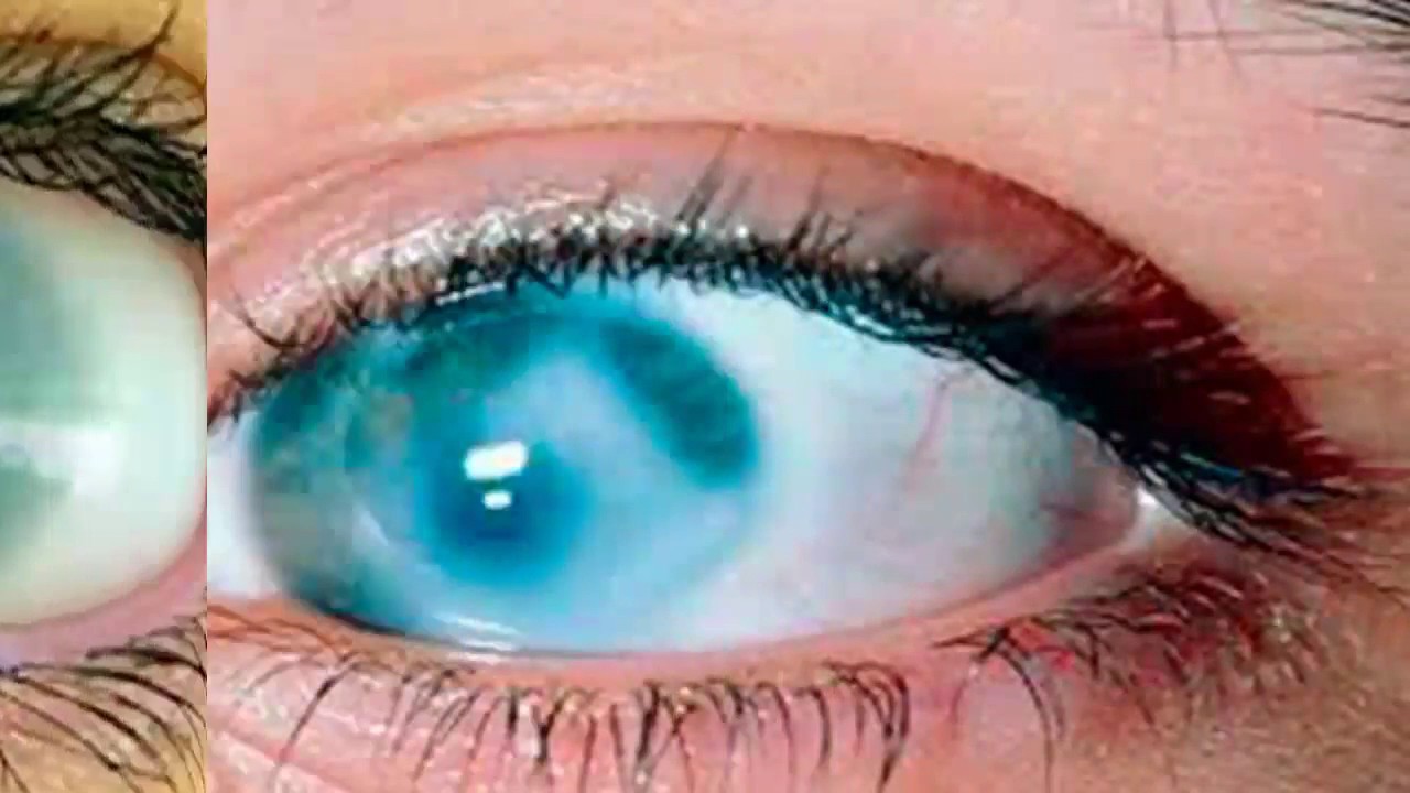 Попадание в глаз кислоты