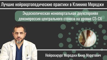 Эндоскопическая монопортальная двухсторонняя декомпрессия центрального стеноза  на уровне C5-C6