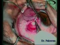 Ahmed Glaucoma Implant Ahmed Glaucoma Implant