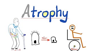 Atrophy Types - Denervation atrophy, Disuse atrophy, Pressure, Hormonal, Vascular - Pathology