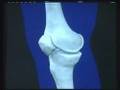 Treatment choices for knee osteoarthritis