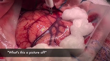 Awake Carniotomy & Speech Mapping for Gliomas from Quinones-Hinojosa, Video Atlas of Neurosurgery