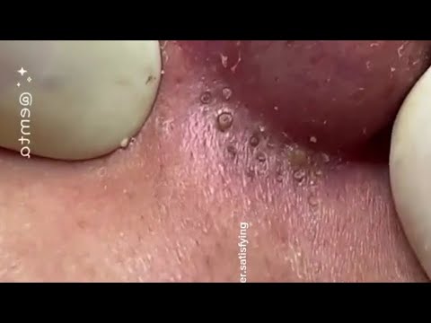 Severe Blackhead Whitehead Removal  - Facial Acne Spa Treatment - Ear Cystic Acne - Relaxing | #132