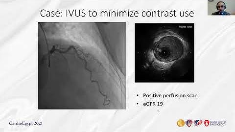 Use of intracoronary imaging with IVUS with case examples