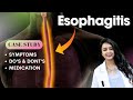 Successful esophagitis ayurvedic treatment at iafa ayurveda  a case study