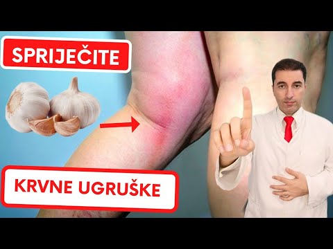 Video: Kako liječiti pseudotumor Cerebri: 13 koraka (sa slikama)