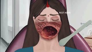 ASMR Animation treatment from infected mouth | 2D Animation @restasmr1
