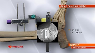 INFINITY Total Ankle System Animation