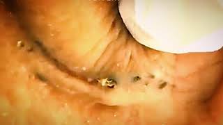 Blackhead Removals in Nose and Ears - Horrible Acne Pits