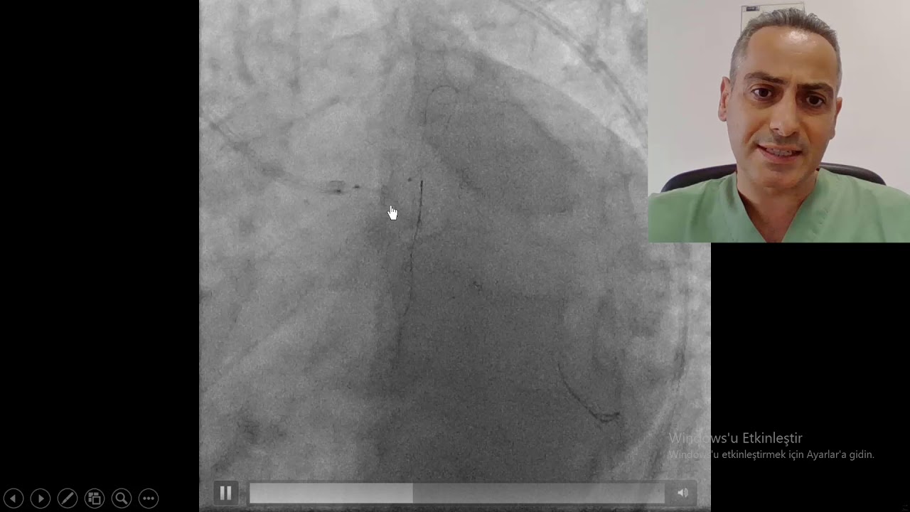 Ana Koroner (LMCA)  Stentlemede Adım Adım DK-Nano Crush Tekniği