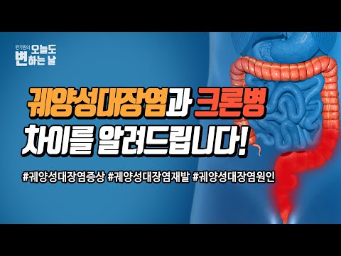 장 전문가가 알려주는 궤양성 대장염과 크론병 차이와 원인!