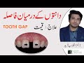 Gap between teeth  diastema  treatment  cost  urdu  hindi  dr inqalab fareed