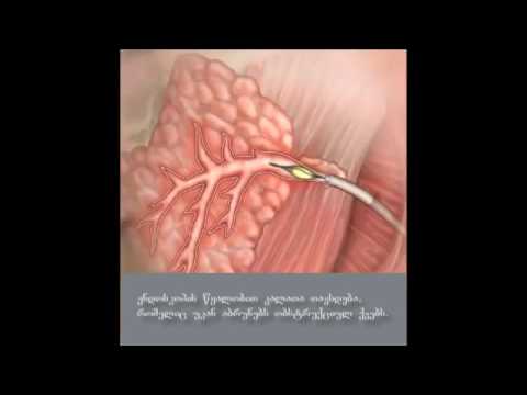 სიალოენდოსკოპია