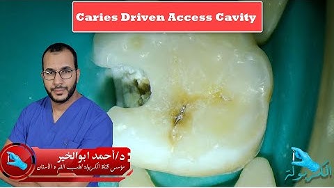 Caries Driven Access Cavity Demo on Lower First Molar (ep 11)