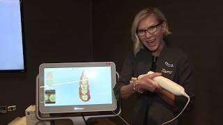 Scanning for a Single-Unit Crown with the iTero Element® 2 Intraoral Scanner