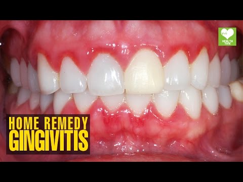 gingivitis-(मसूड़े-की-सूजन)---home-remedies-|-health-tips-|-educational-video